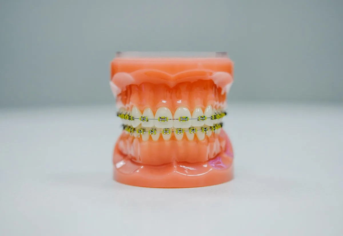 Orthodontic model with braces on the teeth