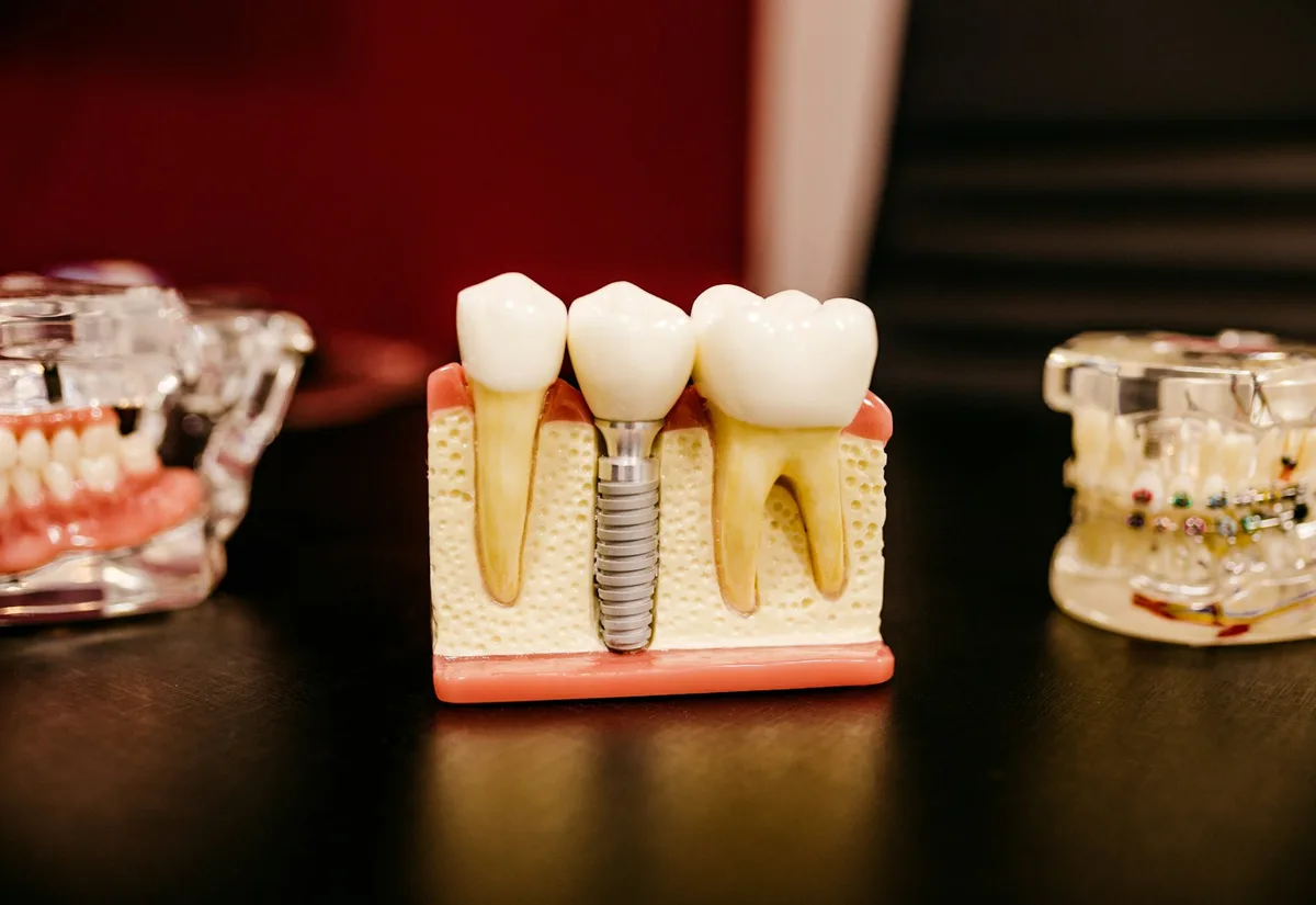 Dental model showing an implant between natural teeth