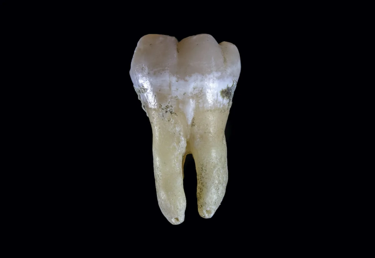 An extracted molar tooth with its roots