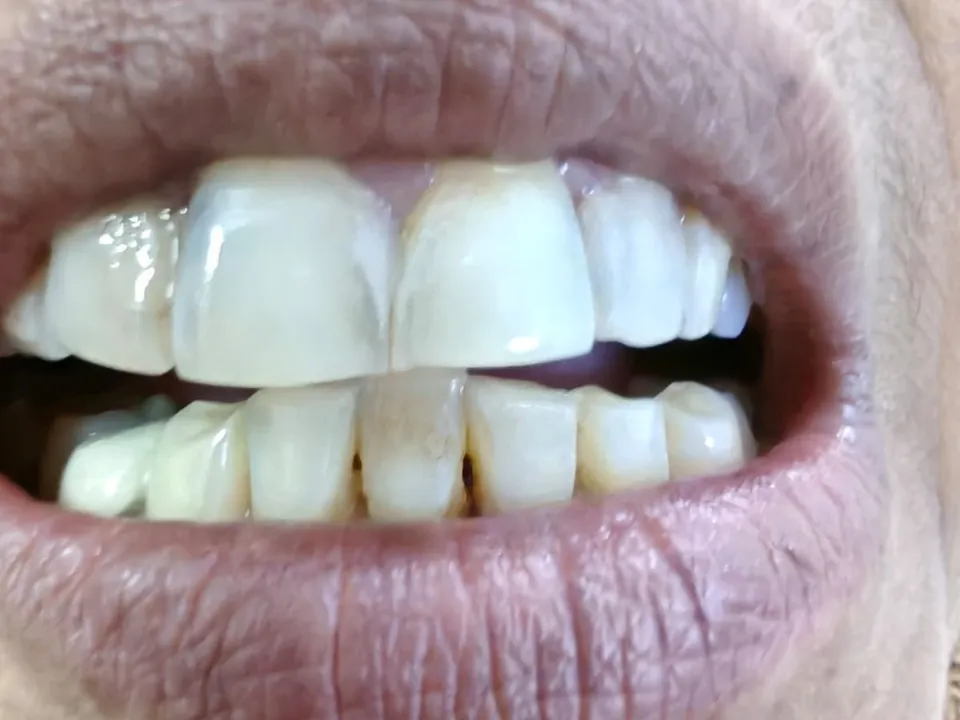 The same front teeth after restoration at Dent-O-Care