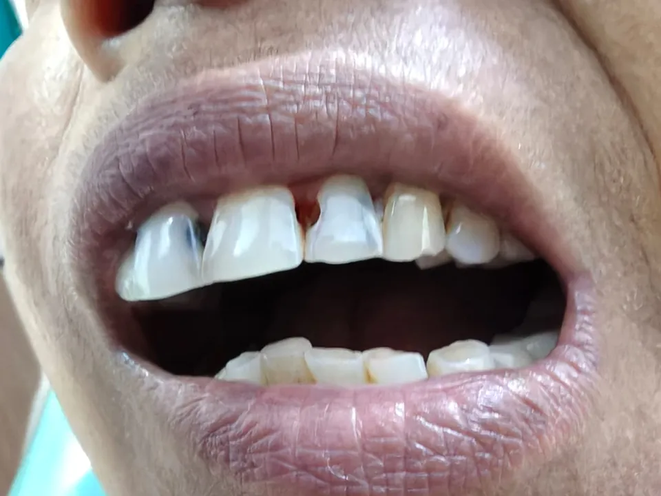 Front teeth with gaps and discolouration before treatment at Dent-O-Care