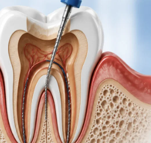 Illustration of a rotary file cleaning the root canal of a tooth