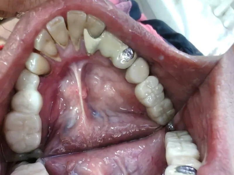 Upper teeth restored with crowns, seen from below, at Dent-O-Care