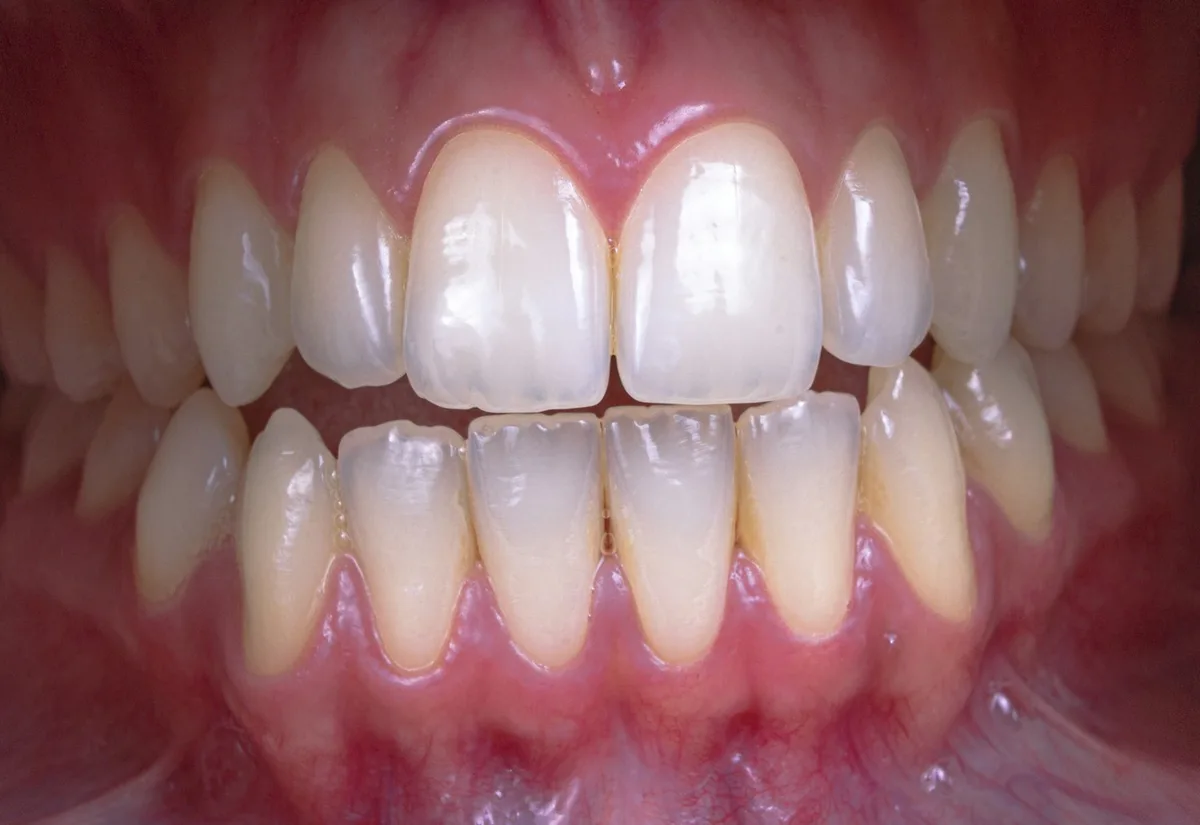 Close-up of bright, white front teeth