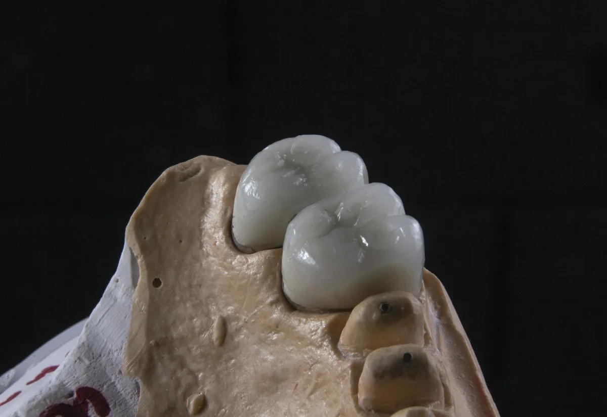 Zirconia crowns fitted on a dental model